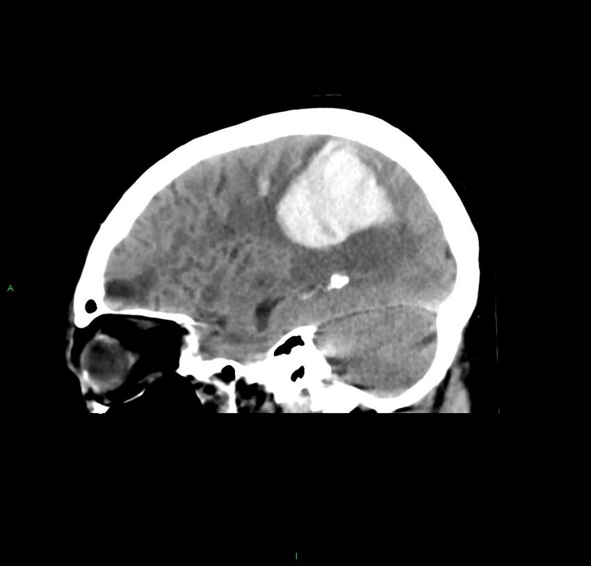 Cerebral amyloid angiopathy-associated lobar intracerebral hemorrhage (Radiopaedia 59356-66716 C 18).jpg