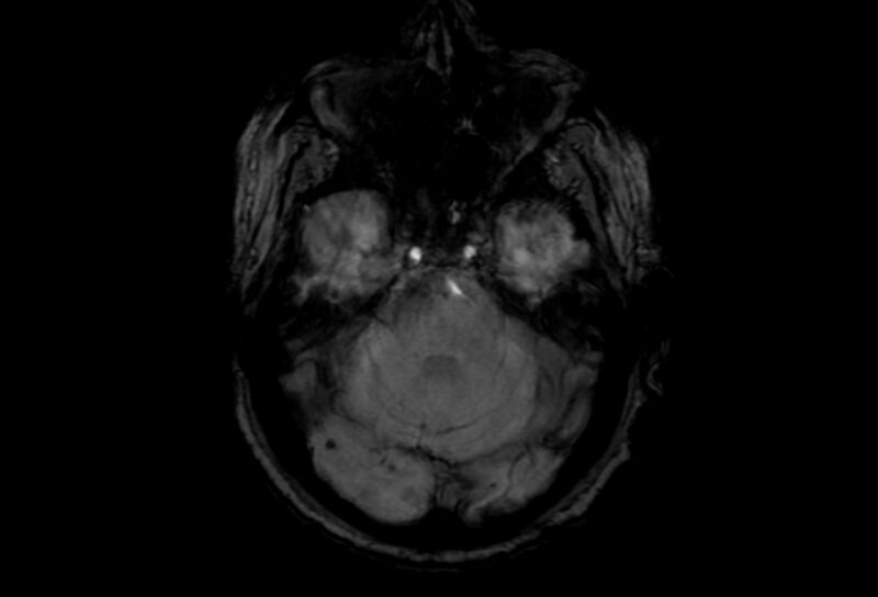 File:Cerebral amyloid angiopathy (Radiopaedia 86671-102792 Axial Gradient Echo 41).jpg