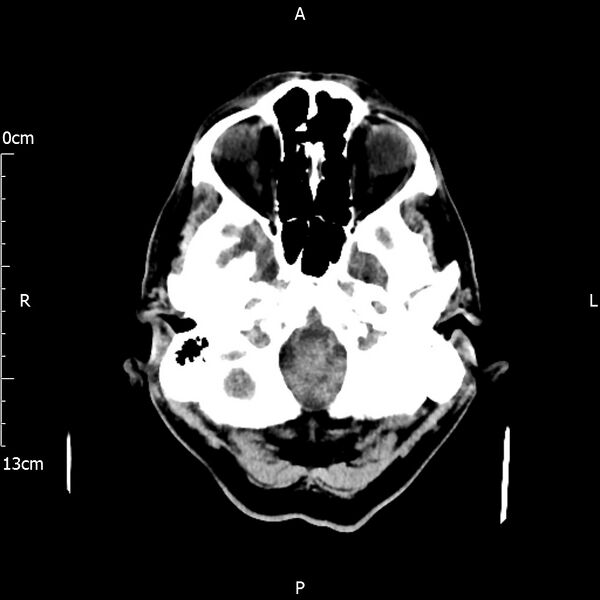 File:Cerebral amyloid angiopathy related inflammation (Radiopaedia 72772-83480 Axial non-contrast 4).jpg