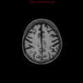 Cerebral and orbital tuberculomas (Radiopaedia 13308-13311 Axial T1 16).jpg
