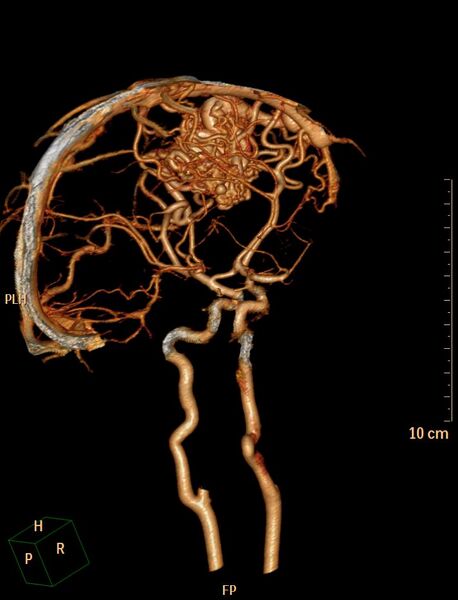 File:Cerebral arteriovenous malformation (Radiopaedia 29531-30031 B 8).jpg