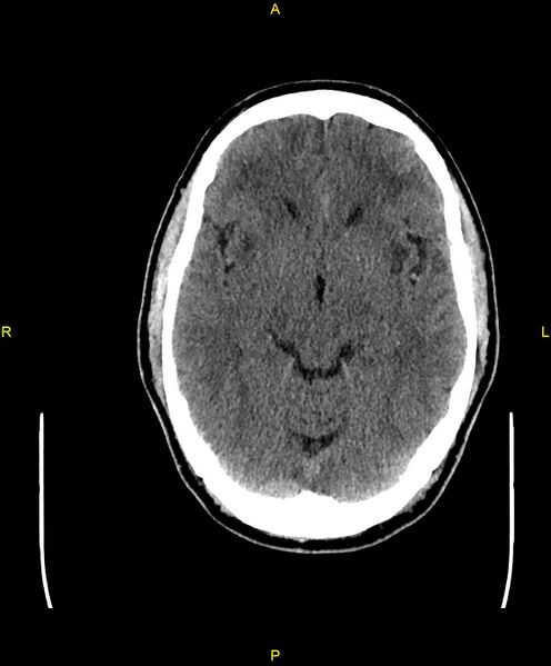 File:Cerebral autosomal dominant arteriopathy with subcortical infarcts and leukoencephalopathy (CADASIL) (Radiopaedia 86108-102051 Axial non-contrast 45).jpg
