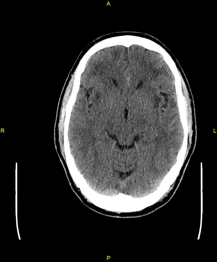Cerebral autosomal dominant arteriopathy with subcortical infarcts and leukoencephalopathy (CADASIL) (Radiopaedia 86108-102051 Axial non-contrast 45).jpg