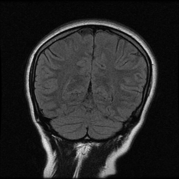 File:Cerebral cavernous malformation (Radiopaedia 44301-47942 Coronal FLAIR 20).jpg