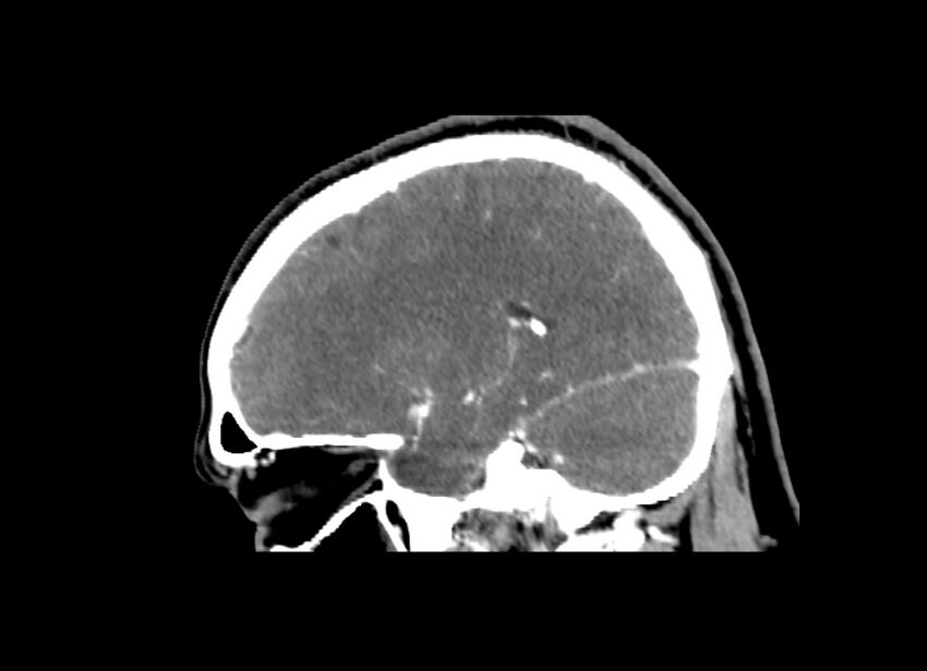 Cerebral edema (Radiopaedia 82519-96661 D 20).jpg