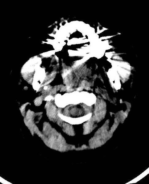 File:Cerebral edema due to severe hyponatremia (Radiopaedia 89826-106938 Axial non-contrast 1).jpg