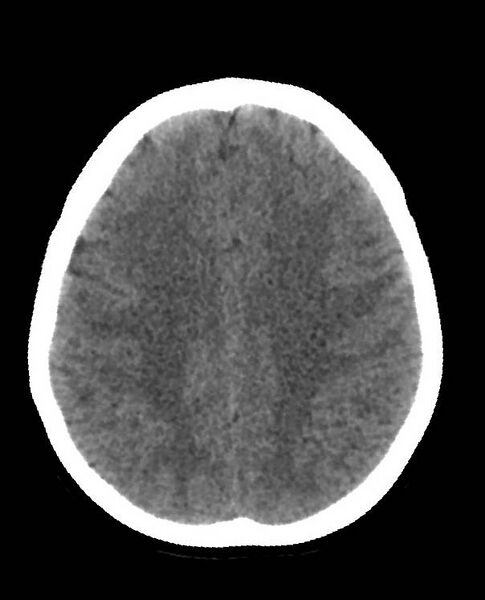 File:Cerebral edema due to severe hyponatremia (Radiopaedia 89826-106938 Axial non-contrast 72).jpg
