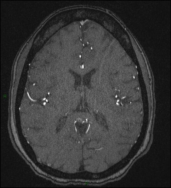 File:Cerebral fat embolism (Radiopaedia 35022-36525 Axial TOF 121).jpg