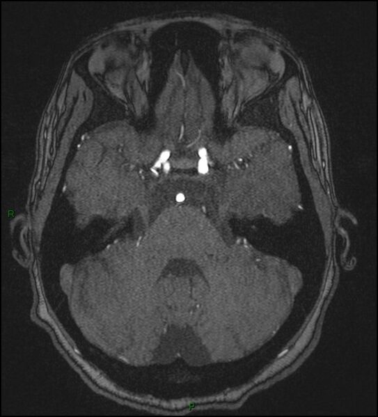 File:Cerebral fat embolism (Radiopaedia 35022-36525 Axial TOF 56).jpg