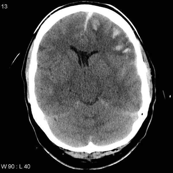 File:Cerebral hemorrhagic contusion with subdural and subarachnoid hemorrhage (Radiopaedia 10680-19197 Axial non-contrast 9).jpg