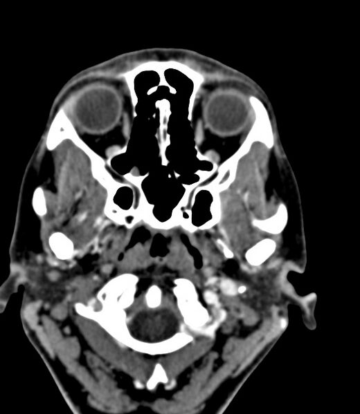 File:Cerebral venous sinus thrombosis (Radiopaedia 59224-66646 Axial C+ delayed 48).jpg