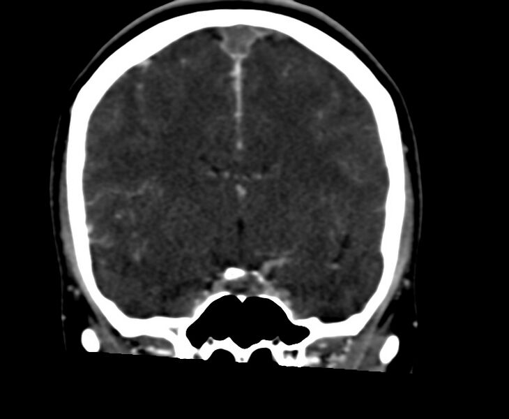 File:Cerebral venous sinus thrombosis (Radiopaedia 59224-66646 Coronal C+ delayed 33).jpg