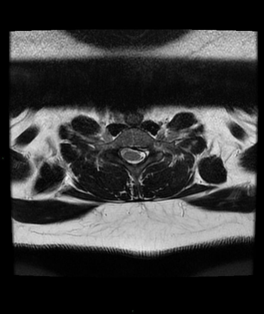 Cervical disc prolapse (Radiopaedia 80258-93598 Axial T2 65).jpg