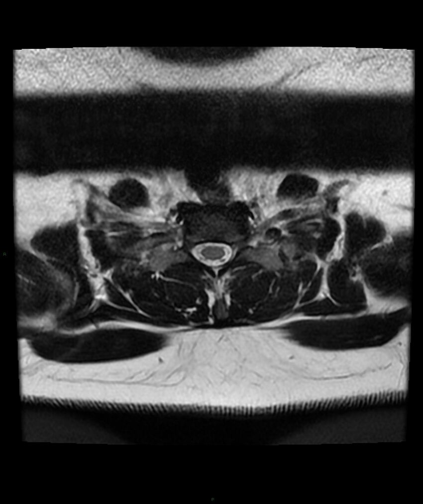 Cervical disc prolapse (Radiopaedia 80258-93598 Axial T2 76).jpg