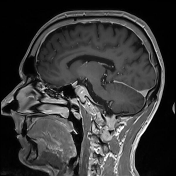 File:Cervical dural CSF leak on MRI and CT treated by blood patch (Radiopaedia 49748-54995 G 46).jpg