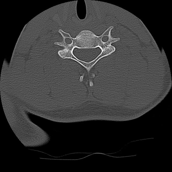 File:Cervical flexion teardrop fracture with cord hemorrhage (Radiopaedia 32497-33454 Axial bone window 58).jpg