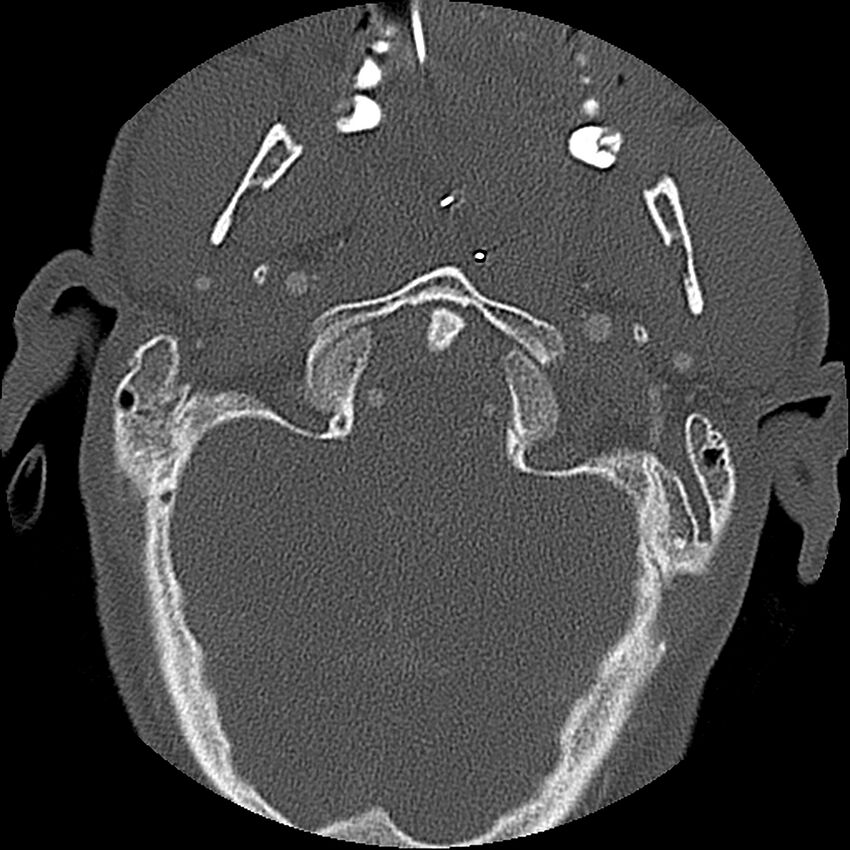 Cervical spine fractures with vertebral artery dissection (Radiopaedia 32135-33078 Axial bone window 72).jpg