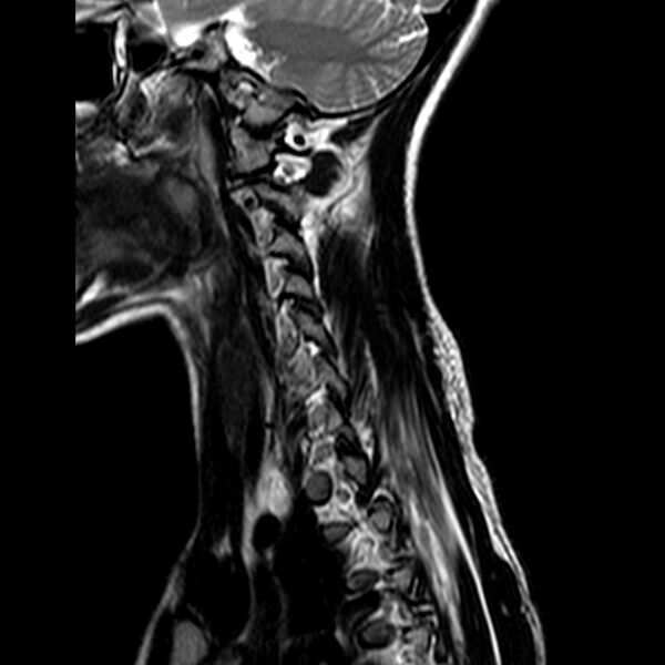 File:Cervical spine posterior ligamentous complex rupture (Radiopaedia 63486-72103 Sagittal T2 12).jpg