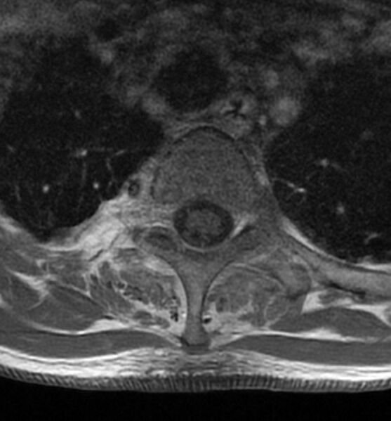 File:Cervical spondylodiscitis (Radiopaedia 81362-95110 Axial T1 C+ fat sat 23).jpg