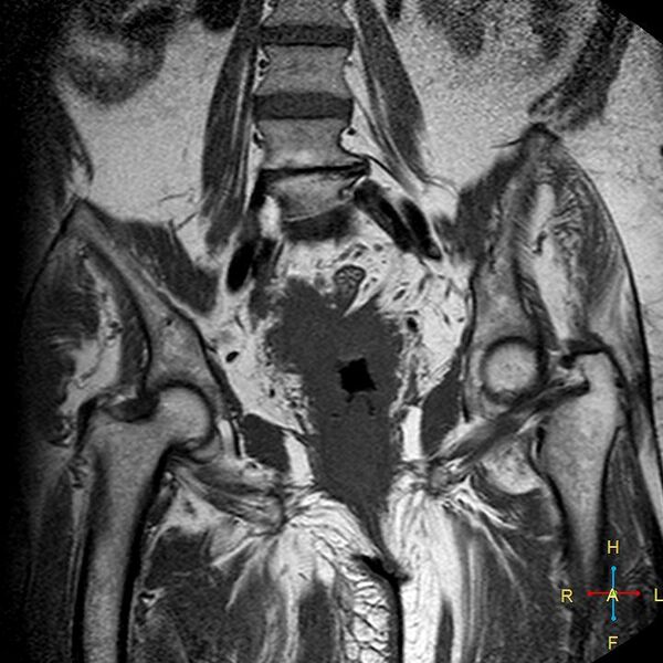 File:Cervical stump squamous cell carcinoma (Radiopaedia 48049-52858 Coronal T1 10).jpg