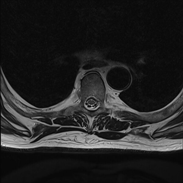 File:Cervical tumor-like myelopathy due to Type V dAVF (Radiopaedia 82461-96604 D 19).jpg
