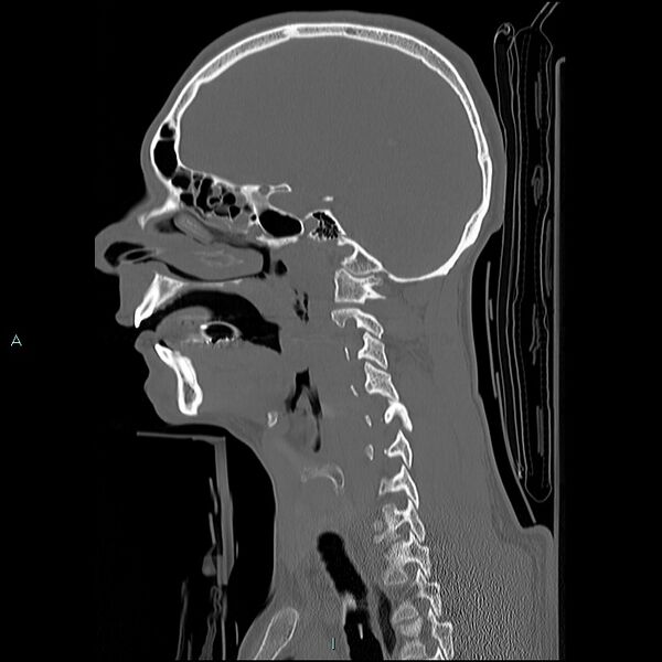 File:Cervical vertebral burst fracture (Radiopaedia 37420-39258 Sagittal bone window 23).jpg