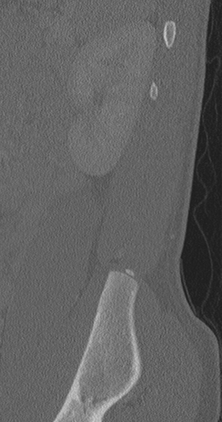 File:Chance fracture (Radiopaedia 40360-42912 Sagittal bone window 12).png