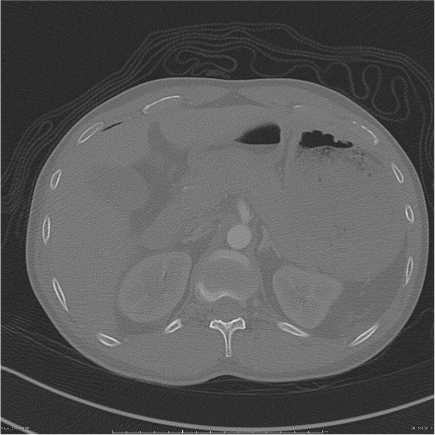 Chest and abdomen multi-trauma (Radiopaedia 26294-26425 bone window 109).jpg