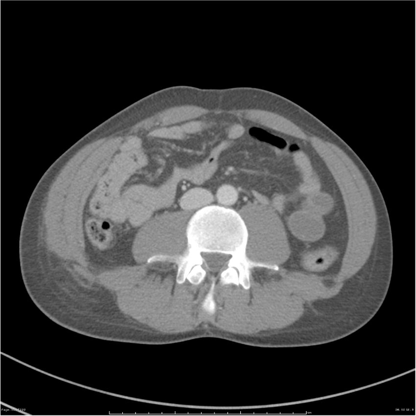 Chest and abdomen multi-trauma (Radiopaedia 26294-26426 A 50).jpg