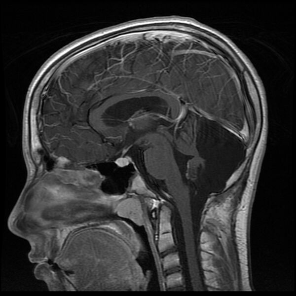 File:Chiasmatic-hypothalamic juvenile pilocytic astrocytoma (Radiopaedia 78533-91236 Sagittal T1 C+ 13).jpg