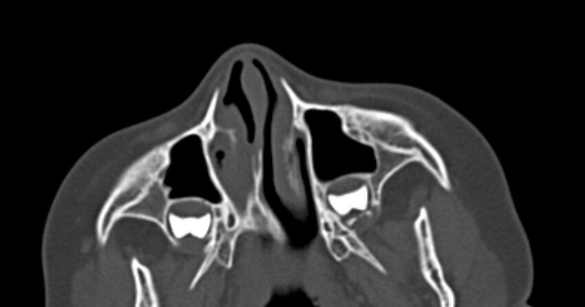 Choanal atresia (Radiopaedia 51295-56972 Axial bone window 16).jpg