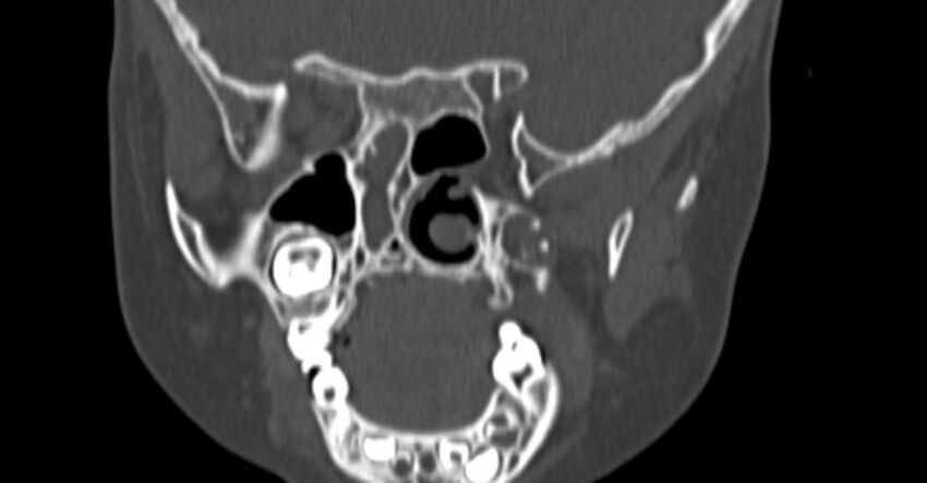 Choanal atresia (Radiopaedia 51295-56972 Coronal bone window 62).jpg