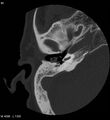 Cholesteatoma (Radiopaedia 5467-7197 Axial bone window 1).jpg