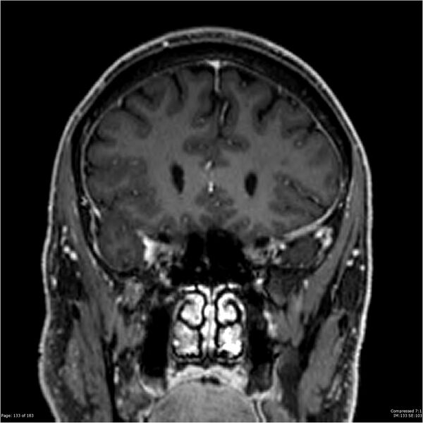 File:Chondrosarcoma of skull base- grade II (Radiopaedia 40948-43654 Coronal T1 C+ 44).jpg