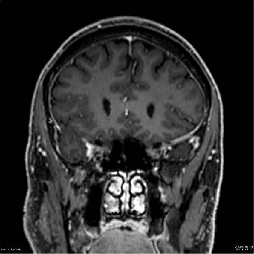 Chondrosarcoma of skull base- grade II (Radiopaedia 40948-43654 Coronal T1 C+ 44).jpg