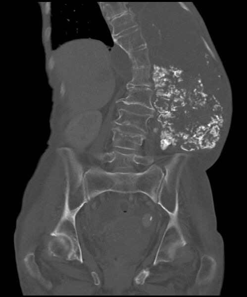 File:Chondrosarcoma of the spine (Radiopaedia 49871-55143 Coronal bone window 12).jpg
