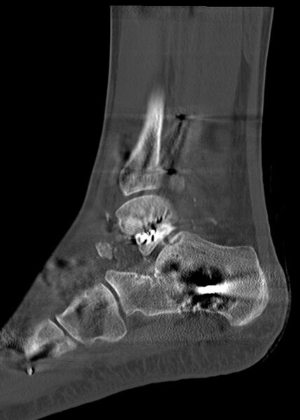 File:Chopart fracture (Radiopaedia 35347-36861 Sagittal bone window 50).jpg