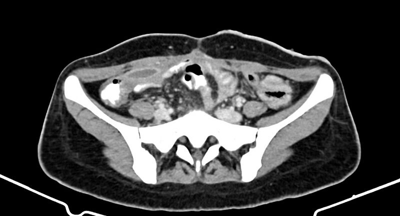 File:Choriocarcinoma liver metastases (Radiopaedia 74768-85766 A 151).jpg