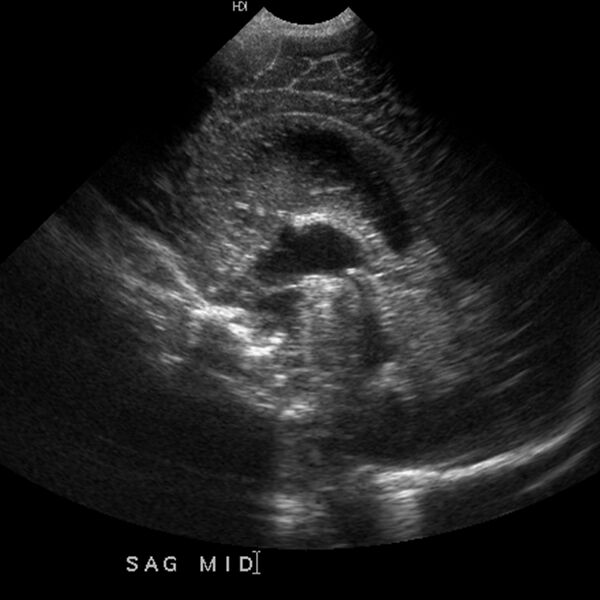 File:Choroid plexus carcinoma (Radiopaedia 21121-21033 A 10).jpg