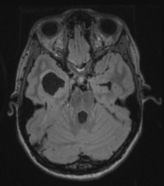 File:Choroid plexus carcinoma (Radiopaedia 91013-108553 Axial FLAIR C+ 107).jpg