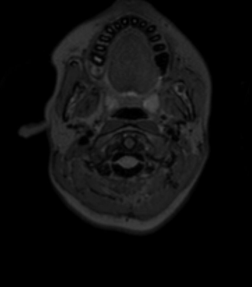 Choroid plexus carcinoma (Radiopaedia 91013-108553 Axial T2 fat sat 17).jpg