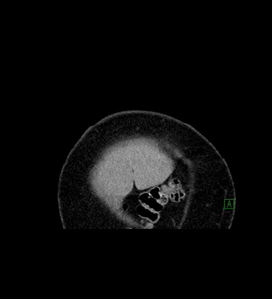 File:Chromophobe renal cell carcinoma (Radiopaedia 84239-99519 C 4).jpg