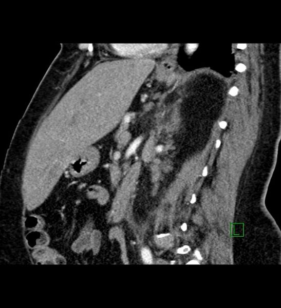 File:Chromophobe renal cell carcinoma (Radiopaedia 84239-99519 D 55).jpg