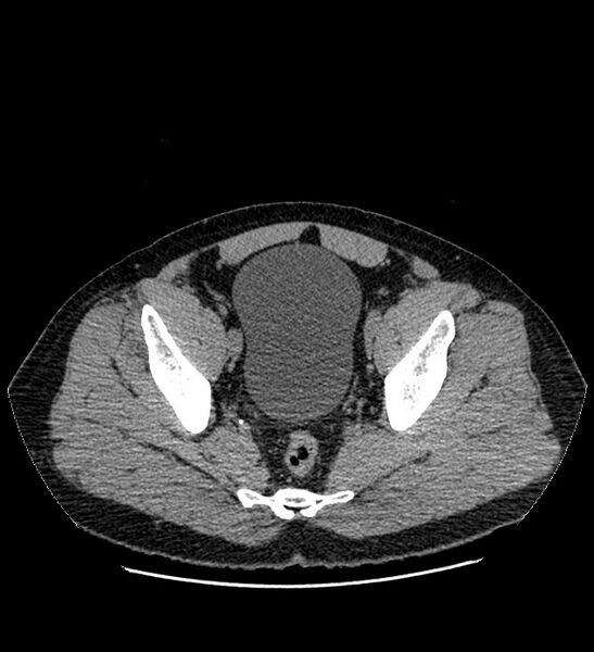 File:Chromophobe renal cell carcinoma (Radiopaedia 84337-99693 Axial non-contrast 138).jpg