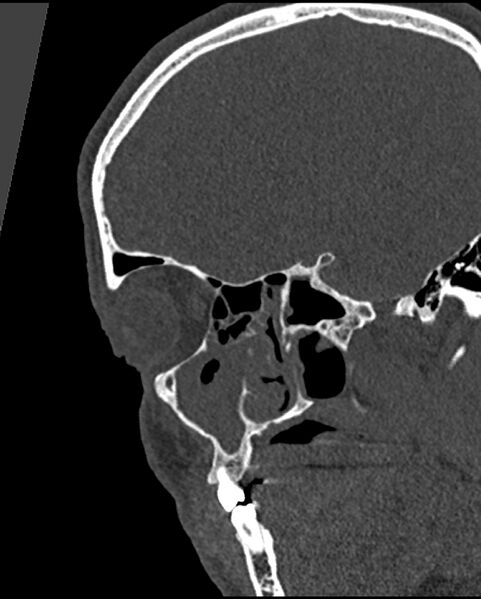 File:Chronic maxillary sinusitis caused by a foreign body (Radiopaedia 58521-65676 Sagittal bone window 11).jpg
