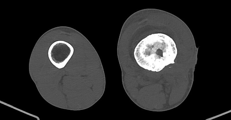 File:Chronic osteomyelitis (with sequestrum) (Radiopaedia 74813-85822 Axial non-contrast 148).jpg