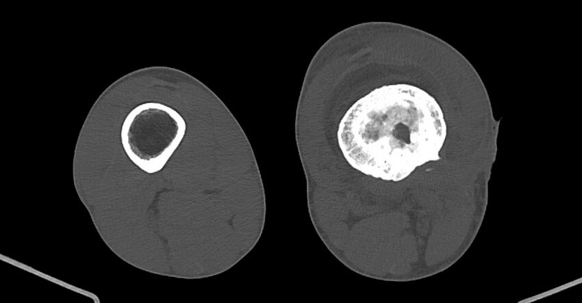 Chronic osteomyelitis (with sequestrum) (Radiopaedia 74813-85822 Axial non-contrast 148).jpg