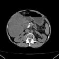 Chronic pancreatitis (Radiopaedia 23132-23172 Axial non-contrast 30).jpg