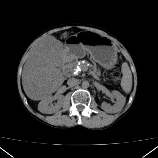 File:Chronic pancreatitis (Radiopaedia 23132-23172 Axial non-contrast 30).jpg