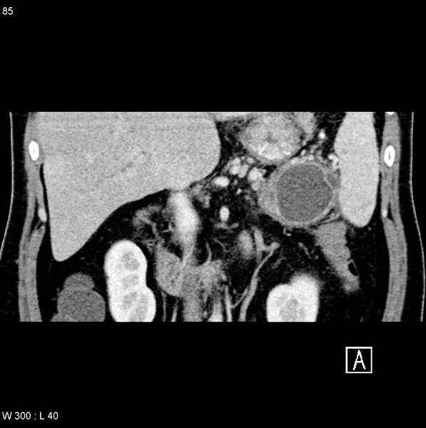 File:Chronic pancreatitis and pseudocysts (Radiopaedia 6724-7935 C 9).jpg